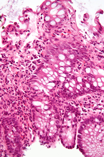 Micrografía muestra inflamación del intestino grueso en un caso de Enfermedad Inflamatoria Intestinal. Biopsia colónica. Tinción hematoxilina-eosina Autor/a e la imagen: Nephron   Fuente: Wikipedia