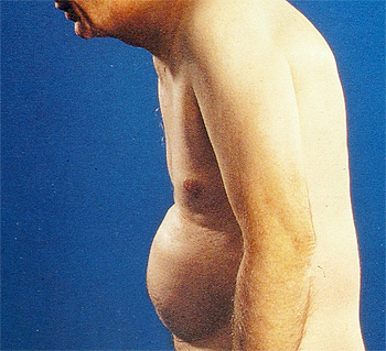 Un espalda afecta de espondilitis anquilosante (Imagen modificada) Autor/a del original: Mehlauge - eigenes Archiv Fuente: Wikimedia Commons 