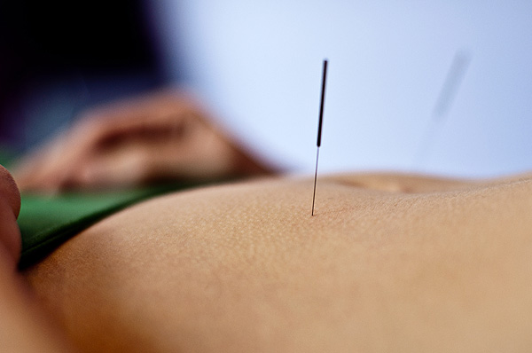 Acupuntura Acupuntura Autor/a de la imagen: Marnie Joyce Fuente: Flickr / Creative Commons