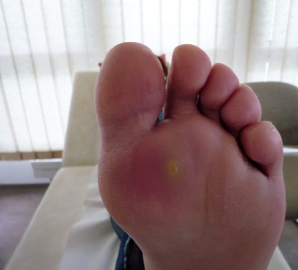 Verruga plantar Farmacosalud