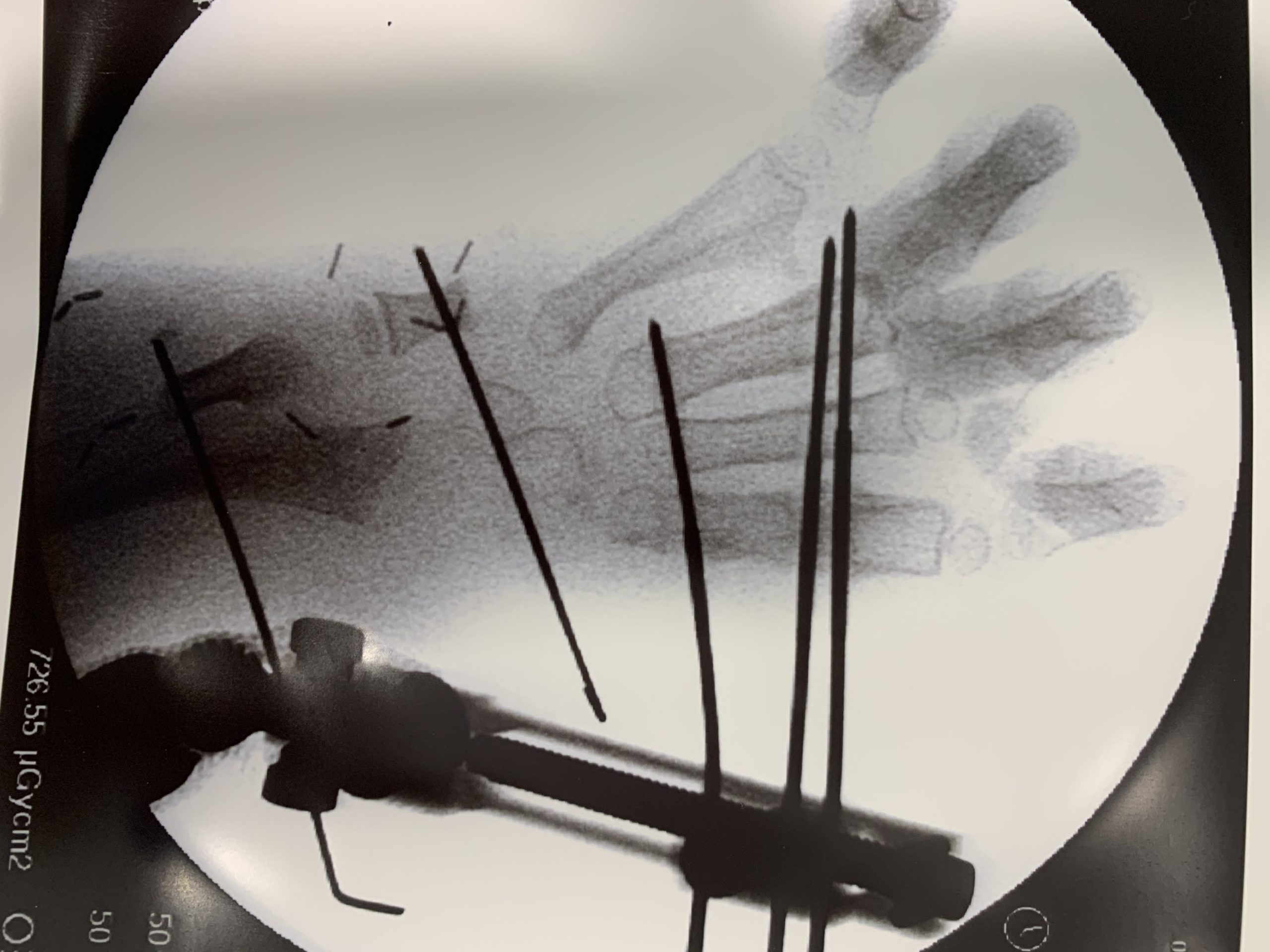 radiografía post intervención técnica de Vilkki Displasia Radial 2 mano  zamba - Farmacosalud