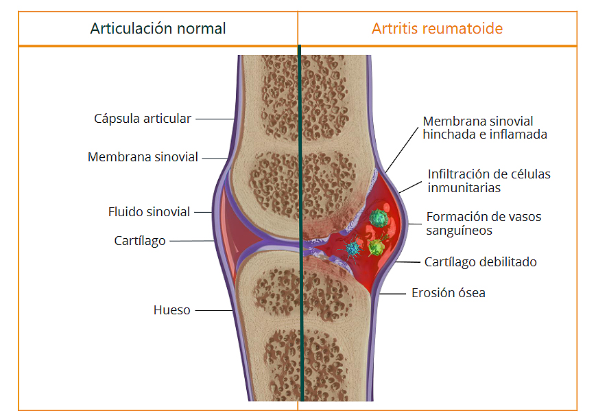 (portada) comparativa articulación artritis reumatoide