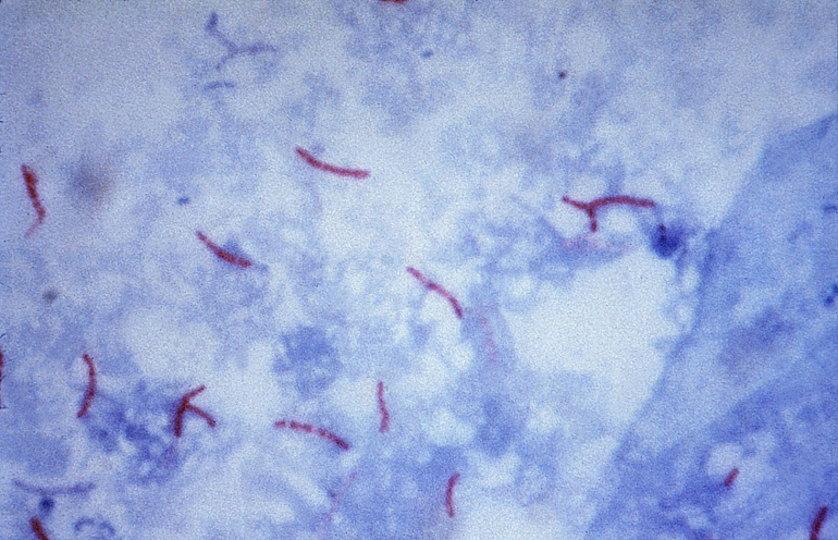 (portada 22) Mycobacterium tuberculosis (causante de la tuberculosis)