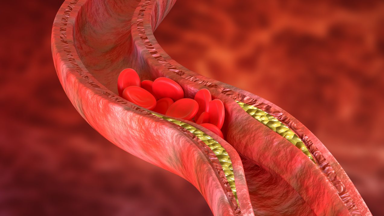 arterioesclerosis ateroesclerosis colesterol trombo trombos hipercolesterolemia Atherosclerosis is an accumulation of cholesterol plaques in the walls of the arteries, which causes obstruction of blood flow.