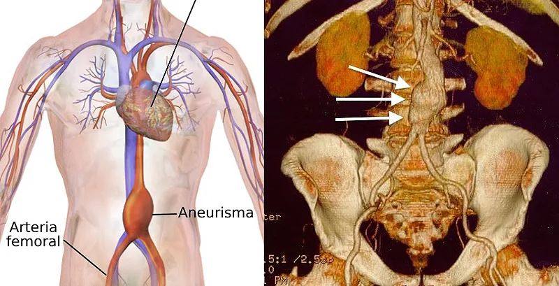 (portada mix) Aneurisma abdominal aneurisma aorta abdominal