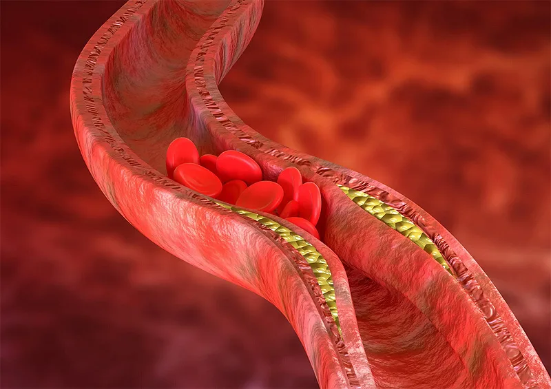 (portada) arterioesclerosis ateroesclerosis colesterol trombo trombos hipercolesterolemia Atherosclerosis