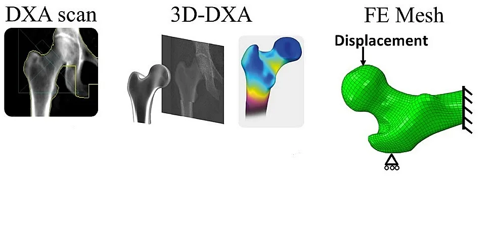 (portada 2) 3D DXA imágenes 3D fémur