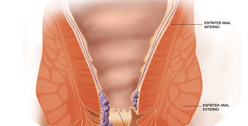 (portada) Hemorroides hemorroidal hemorroide