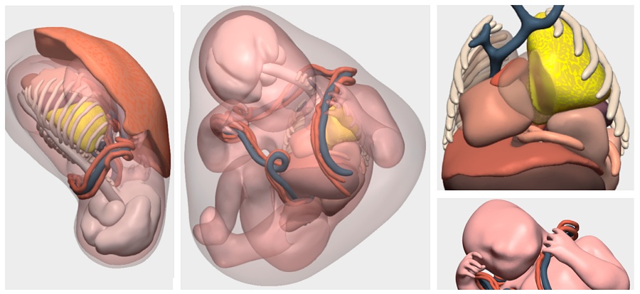 (portada) lesión pulmonar feto 3D