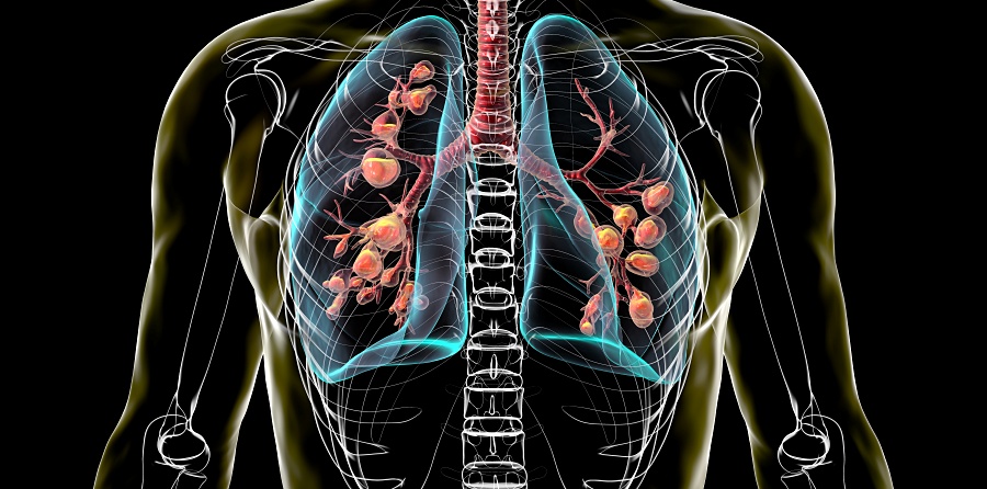 (portada) pulmones pulmonar fibrosis quística