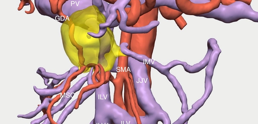 (portada) operación cáncer páncreas reconstrucción tumor tres dimensiones