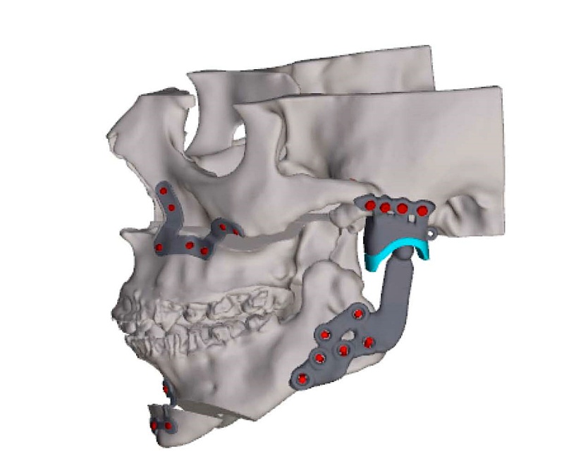 (portada) patología mandibular parálisis braquial congénita 1